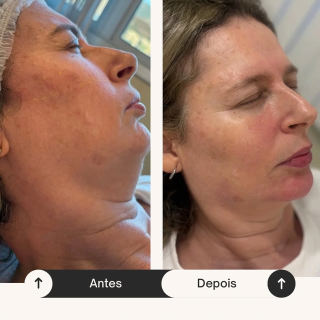 Antes e depois de uma sessão de 45 minutos: rosto de três quartos, com mais contorno na mandíbula e no pescoço no depois.