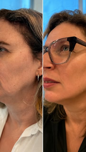 Antes e depois parcial do Protocolo 50+: mulher de cabelo castanho, de perfil no antes e de óculos no depois, com a mandíbula mais firme.