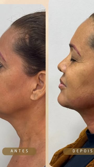 Antes e depois do contorno do pescoço: no antes, papada visível de lado; no depois, perfil com o ângulo do pescoço mais definido.