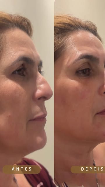 Antes e depois, de perfil: mulher madura com o rosto mais sustentado e o contorno do queixo mais definido no depois.