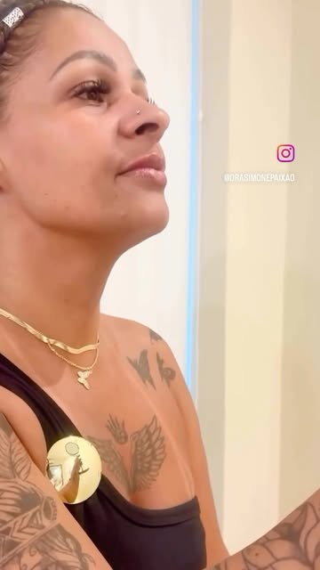 Paciente de perfil, de olhos semiabertos, se olhando no espelho logo depois do preenchimento labial.